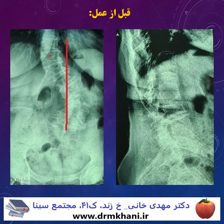 lumbar_deg_scoliosis
