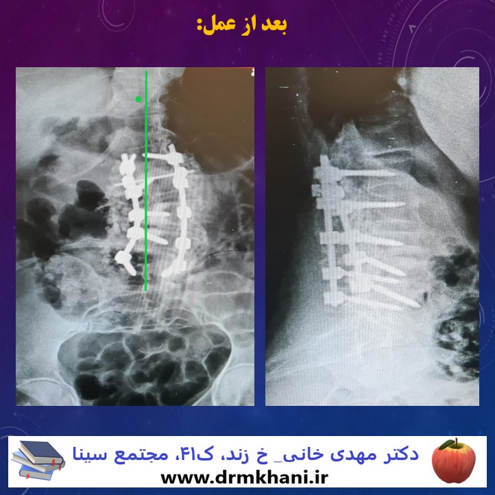 lumbar_deg_scoliosis