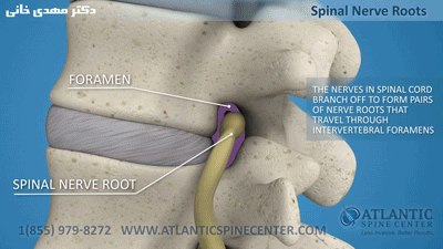 افزایش ارتفاع دیسک و فیوژن جسم مهره ها