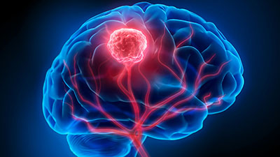 تومور مغزی