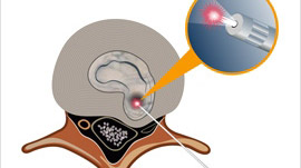 عمل بسته لیزر دیسک