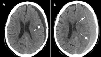 خونریزی مغزی