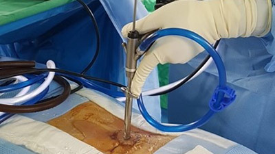 جراحی اندوسکوپیک