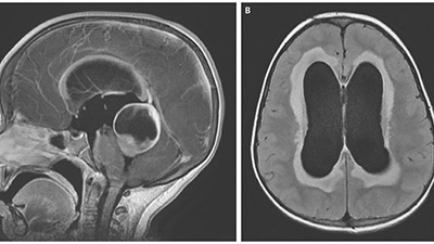 جمع شدن آب در سر