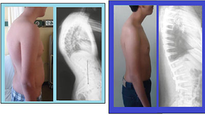 قوز مهره های پشتی