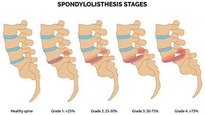 لغزندگی مهره