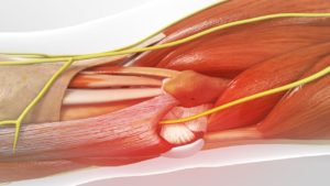 جراحی اعصاب محیطی