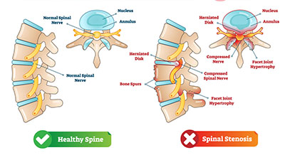 تنگی کانال نخاعی