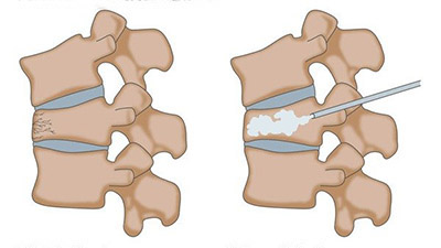 تزریق سیمان در مهره